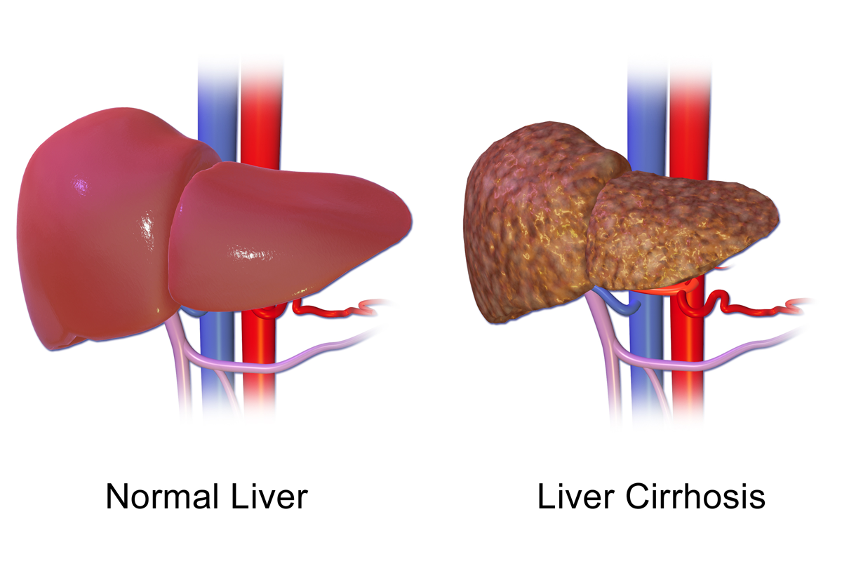 Fatty Liver Disease